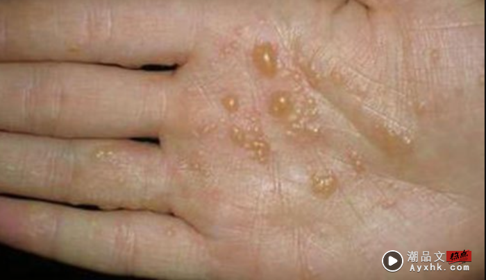 健康｜手脚偶尔冒出小水泡，原来压力大、HIV感染者都会有汗疱疹！ 更多热点 图3张